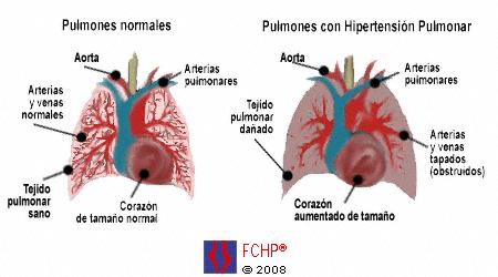 Hipertension.pulmonar.jpg