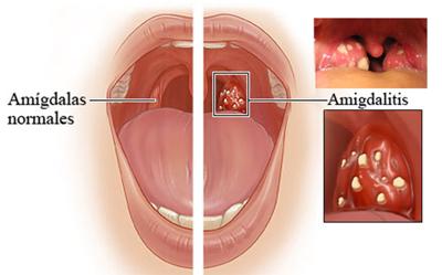 Amigdalitis.jpg