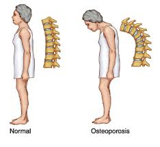 5-osteoporosis