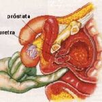 Ficha técnica del Cáncer de Prostata